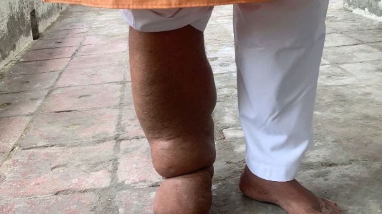 महाराष्ट्र सरकार का बड़ा दावा हाथीपांव उन्मूलन में IDA थेरपी से मिल रही सफलता